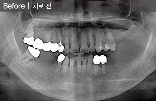 틀니는 지긋지긋해요 치료 전